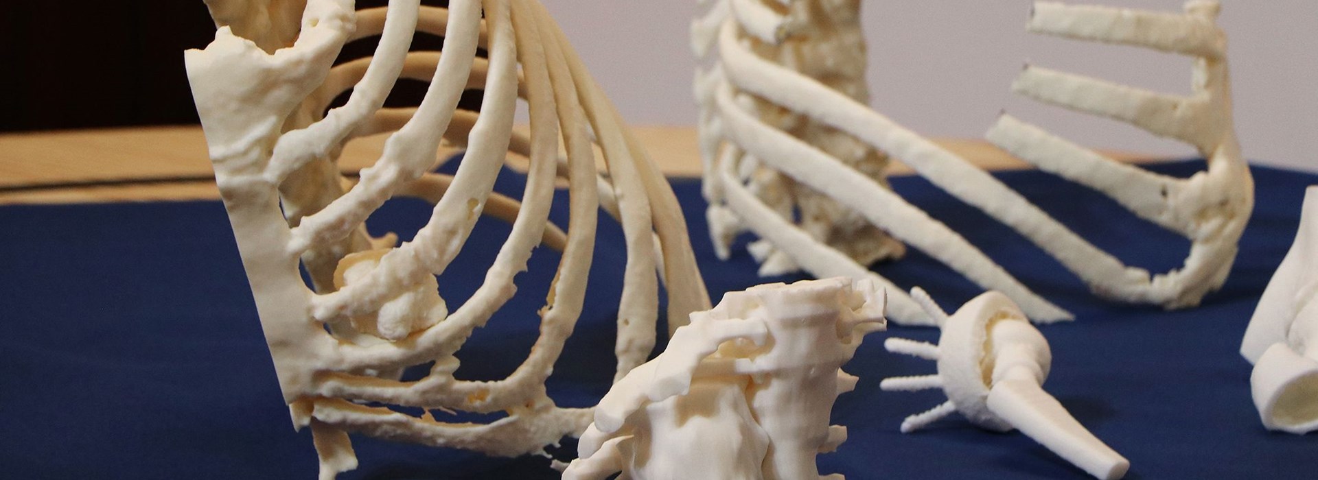 3D printed models of the thoracic wall enable surgeons to plan, perform and perfect the resection on the 3D model ahead of the actual surgery.